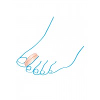 Межпальцевые ортопедические разделители Крейт С-401